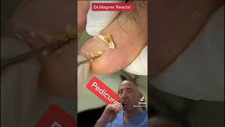 TRIMMING OF INGROWN INCURVATED NAIL💥#shorts