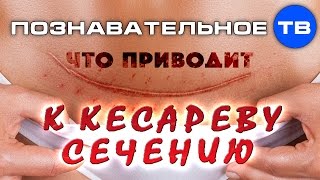 Что приводит к кесареву сечению (Познавательное ТВ, Владимир Базарный)