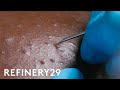 I Got Professional Blackhead Extractions | Macro Beauty | Refinery29