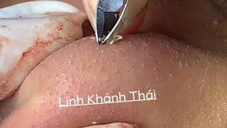 Pha gắp mụn siêu kinh điển