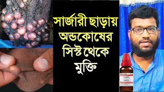 অন্ডকোষের গুটি সিস্ট এর হোমিও চিকিৎসা | scrotal sebaceous epidermal cyst homeopathy medicine