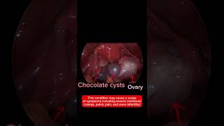 Excision of Ovarian Endometriosis Without Damaging the Ovaries!