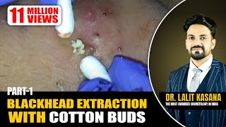 BLACKHEAD EXTRACTION WITH COTTON BUDS PART - 1