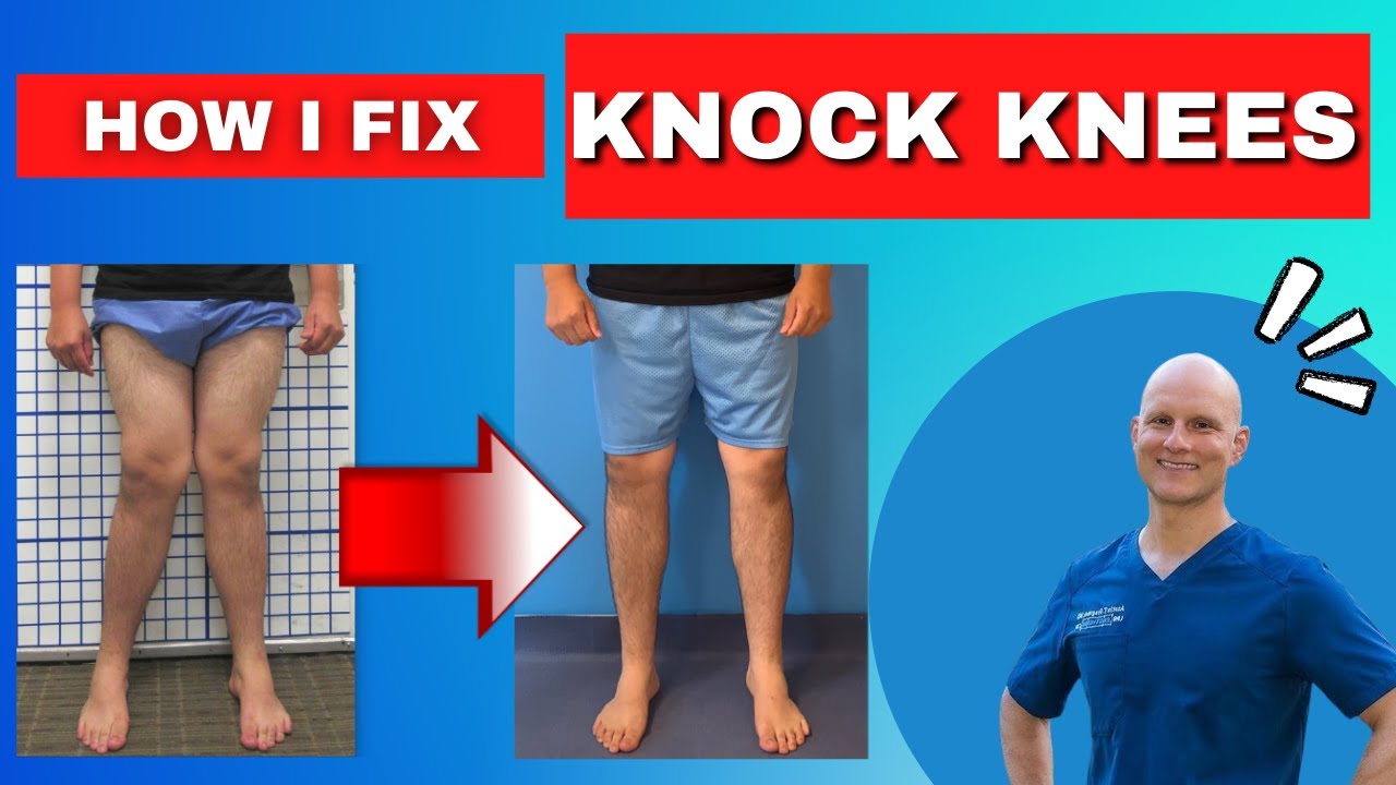 The ONLY Way To Fix Knock Knees! - Get The Facts - YouTube