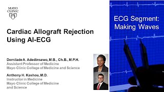 Cardiac Allograft Rejection Using AI-ECG