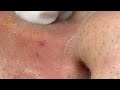 loan nguyen acne treatment 4041