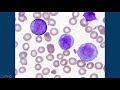 acute myeloid leukemia aml w monocytic differentiation formerly amml with blasts u0026 promonocytes