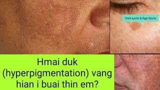 Hmai duk (hyperpigmentation lo awm chhan leh ven dan.@mrpharmacist629