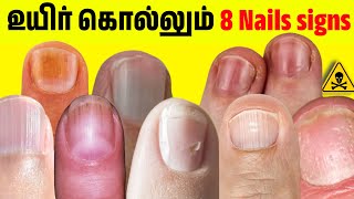 8 dangerous nail sign| உங்க விரல் நகம் நல்லா இருக்கா? Nail signs of Disease