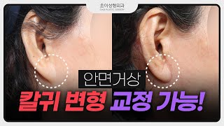 안면거상 부작용 1탄 - 칼귀 변형 / 칼귀 교정 / 칼귀가 생기는 이유? [초이성형외과]