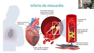 Ejercicio  III, isquemia, lesion necrosis