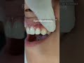 NO BRACES smile makeover in 2 weeks by cosmetic dentist Dr Trivikram