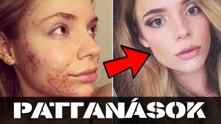 ❗️6 biztos ❗️MEGOLDÁS a PATTANÁSOK (acne) ellen - Mindenkinek segít 😲