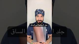 علاج جلد الوزه