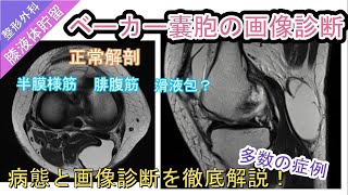 ベーカー嚢胞（ベーカー嚢腫、膝窩嚢胞）の画像診断