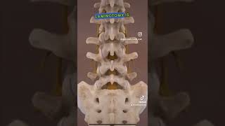 What is Laminotomy