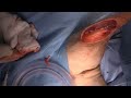 Medial Patellar Luxation Repair in a dog. Dr. James Simcock