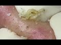 Big blackheads removal - pimple popping - Nhat Bang Acne Treatment - Chuyen Nguyen Spa #7