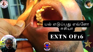 SIMPLE TOOTH EXTRACTION16 | பல் எடுப்பது எவ்ளோ ஈசியா