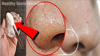 ब्लैकहेड्स और वाइटहेड्स को सिर्फ 5 मिनट में हमेशा के लिए हटाए | Remove Blackheads \u0026 Whiteheads 100%