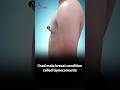 Male Breast Reduction Surgery Result! Gynecomastia #shortsviral