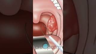 🩺 Tonsillectomy Explained: Surgery \u0026 Recovery 🏥 #shorts #preop #healthcare Pt. 2