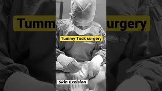 Tummy tuck surgery | Belly shaping | abdomen Liposuction |  Liposuction | লাইপোসাকশন Dr Iqbal Ahmed