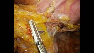 Laparoscopic sigmoid resection