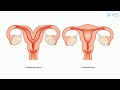 bicornuate uterus