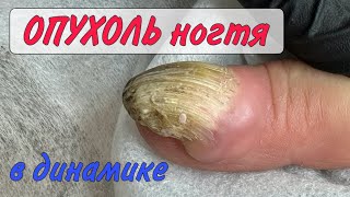 Опухоль на пальце/онихоматрикома/сложный случай