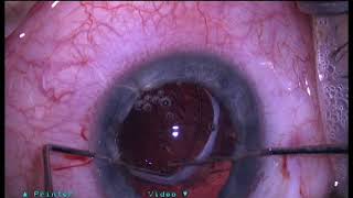 IOL repositioning and fixation with a CTS