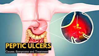 Peptic Ulcers, Causes, Signs and Symptoms, Diagnosis and Treatment.