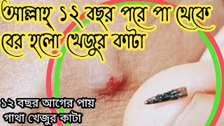 আল্লাহ্ ১২ বছর পরে পা থেকে বের হলো গেথে থাকা খেজুর কাটা⚠️⚠️