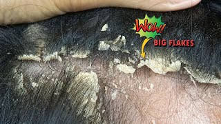 Big Dandruff Flakes In Hair Removal #1078