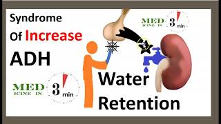 3 Minutes SIADH Causes Symptoms Treatment Syndrome of inappropriate antidiuretic hormone USMLE NCLEX