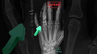 கை விரல் எலும்பு முறிவு அறுவை சிகிச்சை|Finger Fracture surgery|Finger surgery|Phalynx Fracture