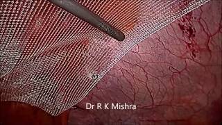 Laparoscopic Repair of Umbilical Hernia
