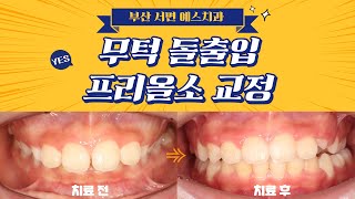 어린이교정) 무턱과 돌출입을 가지고 있나요? 성장기 어린이의 아래턱을 자라게 할 수 있습니다!😊 💕서면예스치과 💕