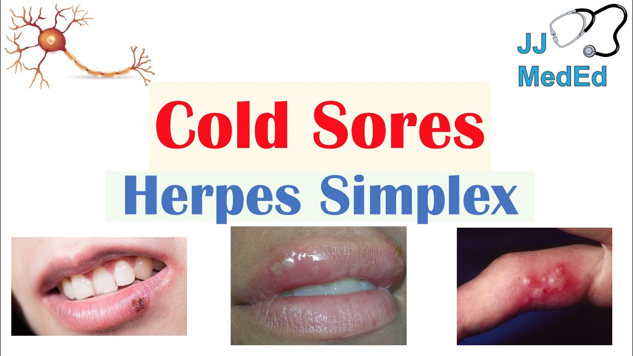 Cold Sores | Oral Herpes | Causes, Signs & Symptoms, Treatment - YouTube