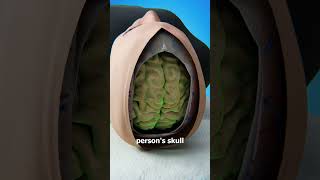 Is It Possible To Swap Brains