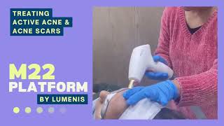 Acne Scar treatment in Ludhiana, Punjab with M22 Laser by Lumenis at Refine Aesthetic Clinic