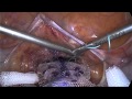 Laparoscopic lateral suspension for pelvic organ prolapse, performed by Prof. Jean-Bernard Dubuisson