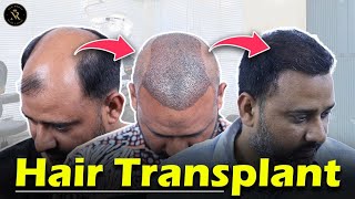 5 Months Hair Transplant Result | New Roots Bangladesh |