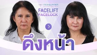 รีวิวดึงหน้า Facelift เช็คกันยันแพทยสภา ลูกสาวจับมือคุณแม่ทำสวย ข้อมูลเป๊ะ ศึกษานาน