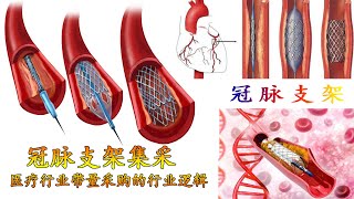 冠脉支架集采  医疗行业带量采购的行业逻辑