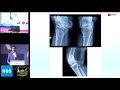 Primary or Complex TKA - Dr. R. Bhalodia