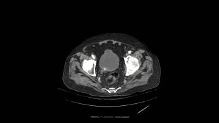 Hydronephrosis caused by Foley catheter insertion