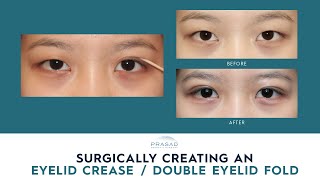 How an Eyelid Crease is Created with Double Eyelid Surgery