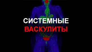 Системные васкулиты