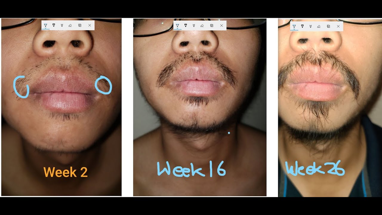 Minoxidil Beard Asian - 6 Months Result Part I - YouTube